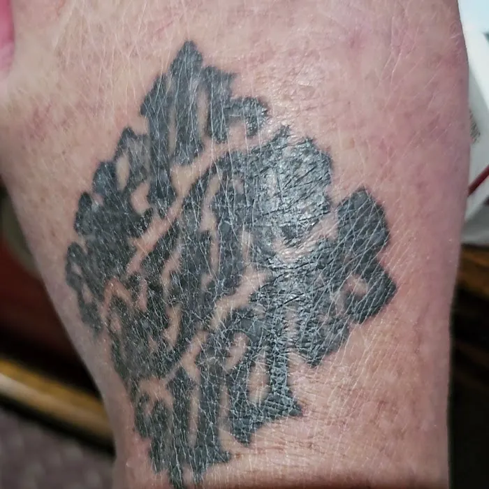 Removery Tattoo Removal & Fading 4