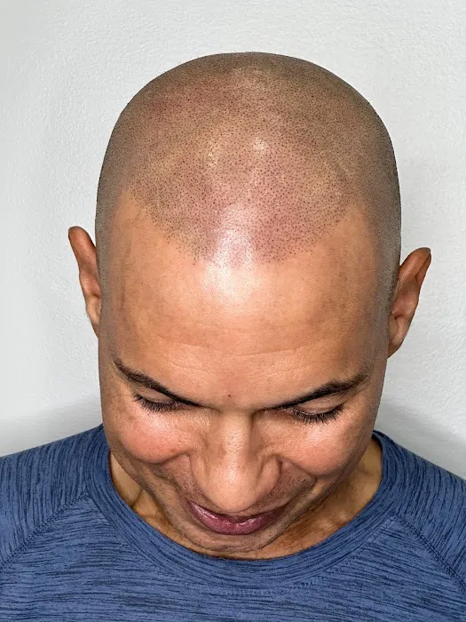 Prodigy SMP Scalp Micropigmentation 0