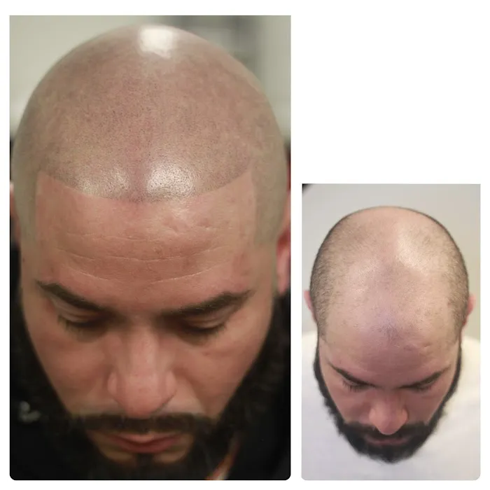 Prodigy SMP Scalp Micropigmentation 2