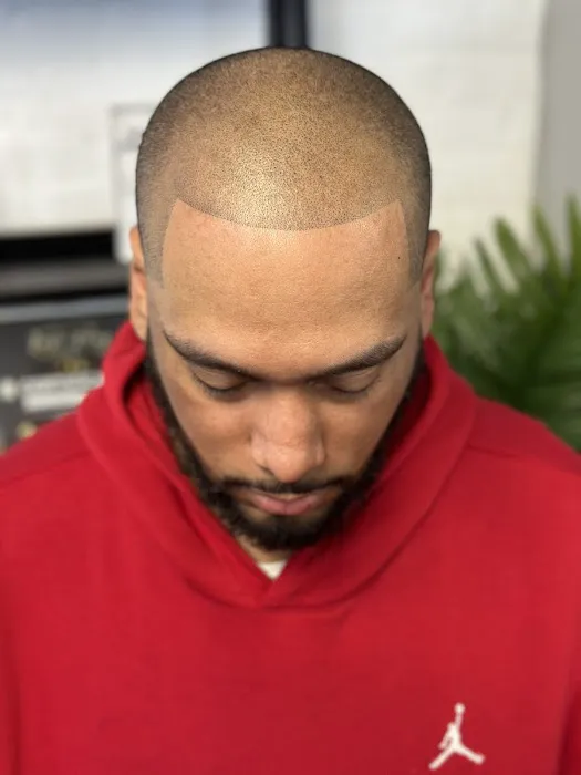 Prodigy SMP Scalp Micropigmentation 3