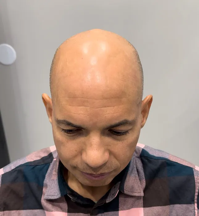 Prodigy SMP Scalp Micropigmentation 9