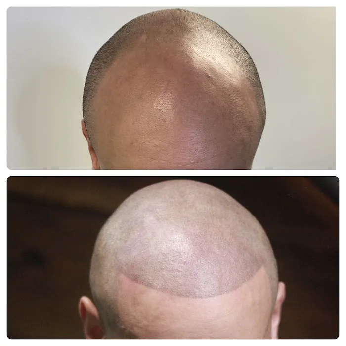 Prodigy SMP Scalp Micropigmentation 4