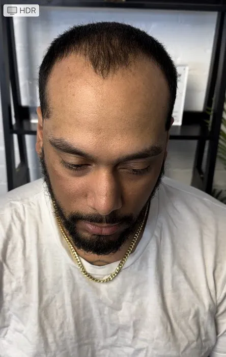 Prodigy SMP Scalp Micropigmentation 1