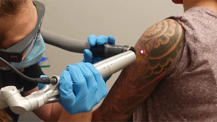 Removery Tattoo Removal & Fading 8