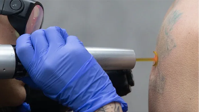 Removery Tattoo Removal & Fading 1