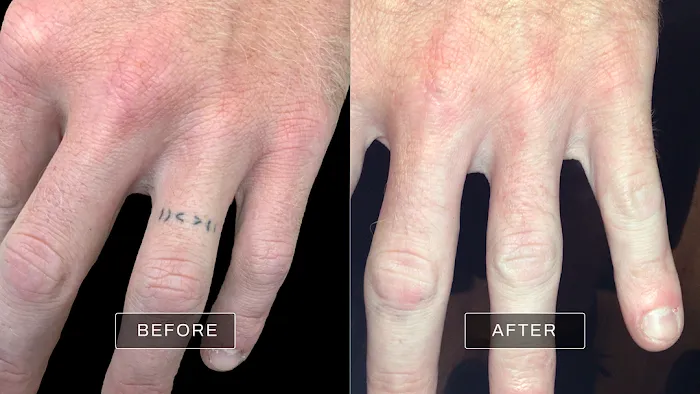 Removery Tattoo Removal & Fading 5