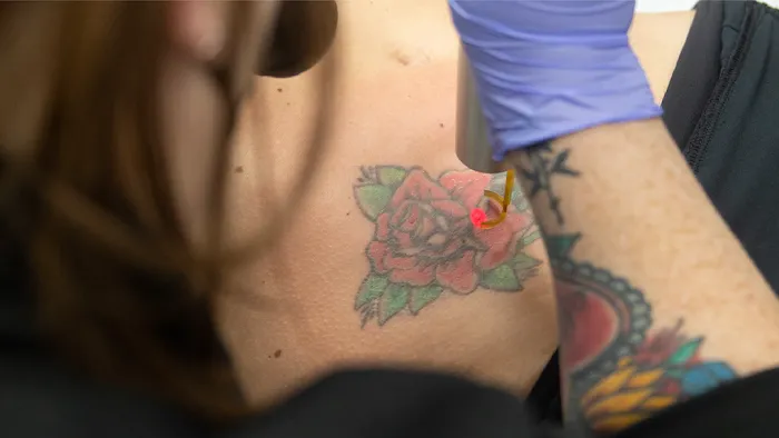 Removery Tattoo Removal & Fading 8