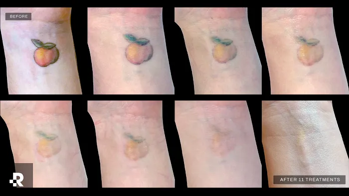 Removery Tattoo Removal & Fading 7