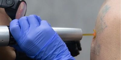 Removery Tattoo Removal & Fading