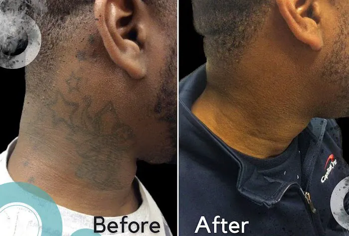 Removery Tattoo Removal & Fading 2