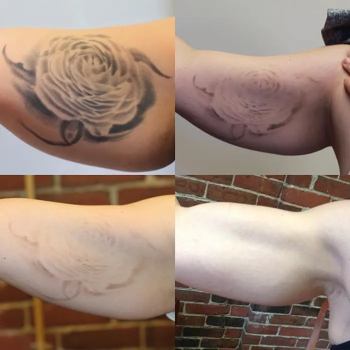 Removery Tattoo Removal & Fading 3