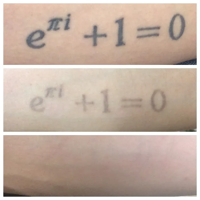 Worcester Tattoo Removal 8