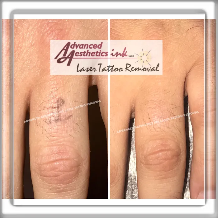 Advanced Aesthetics Ink Laser Tattoo Removal 7