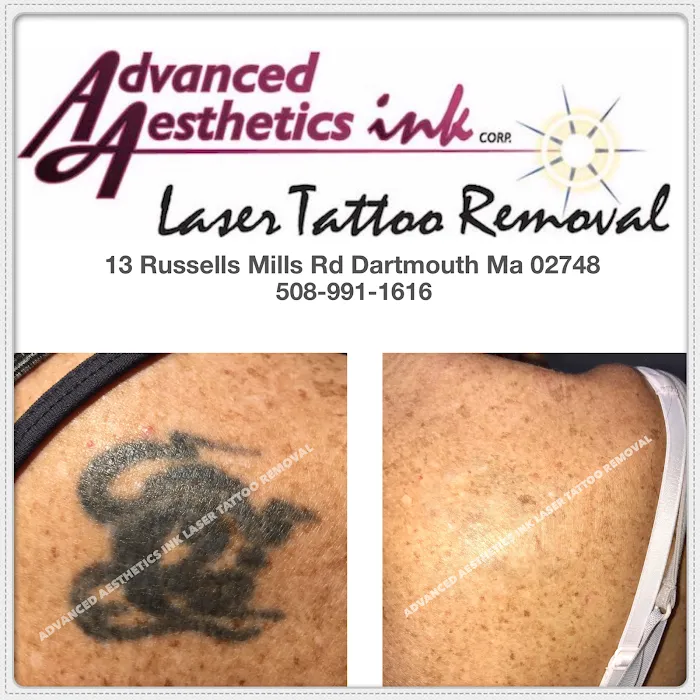 Advanced Aesthetics Ink Laser Tattoo Removal 9