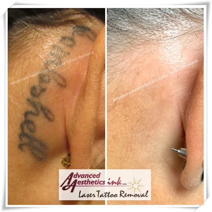 Advanced Aesthetics Ink Laser Tattoo Removal 8