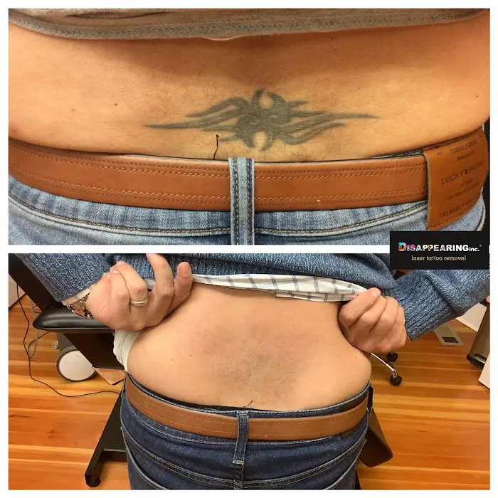Removery Tattoo Removal & Fading 6