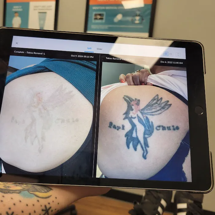 Removery Tattoo Removal & Fading 7