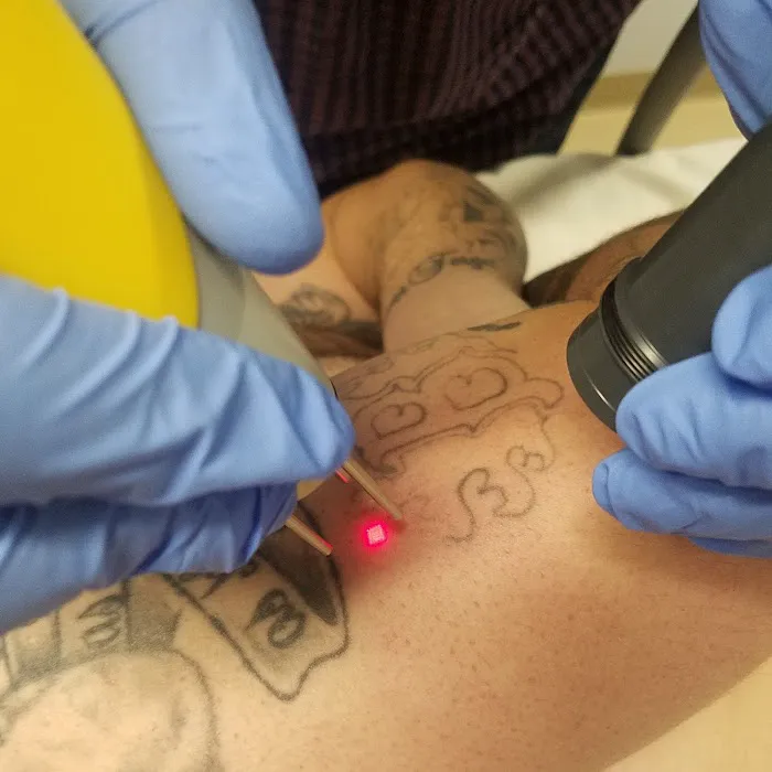 New Beginnings Laser Tattoo Removal 4