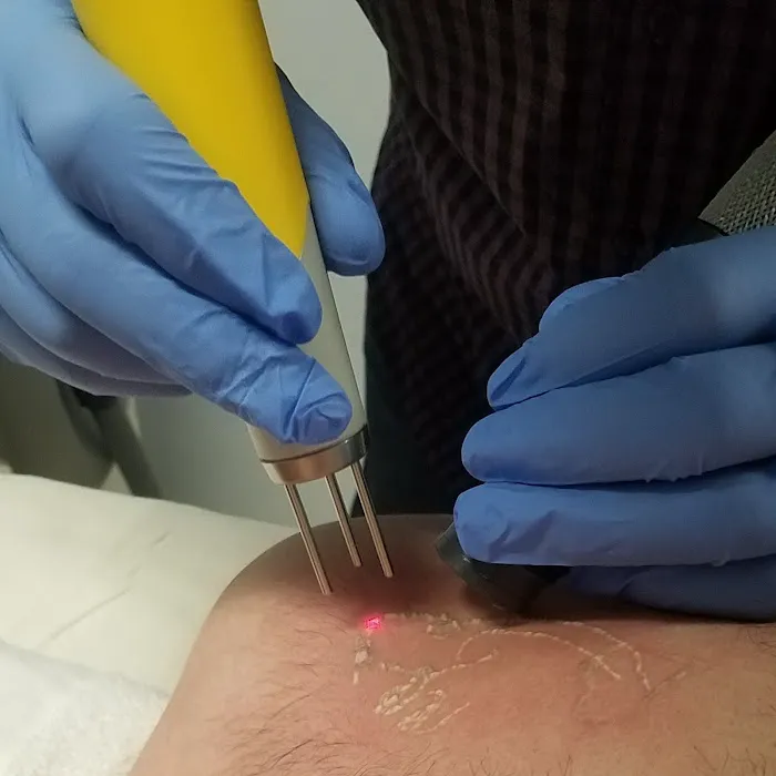New Beginnings Laser Tattoo Removal 3