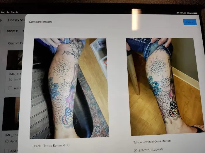Removery Tattoo Removal & Fading 4