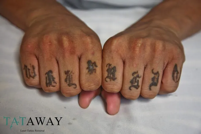 Removery Tattoo Removal & Fading 4