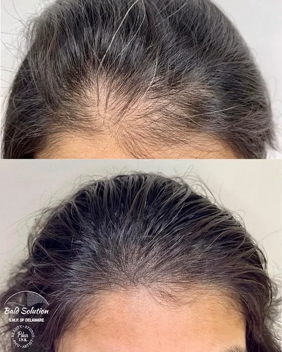 Bald Solution LLc Scalp Micropigmentation 8
