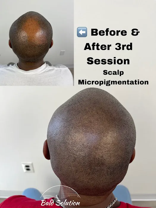 Bald Solution LLc Scalp Micropigmentation 2