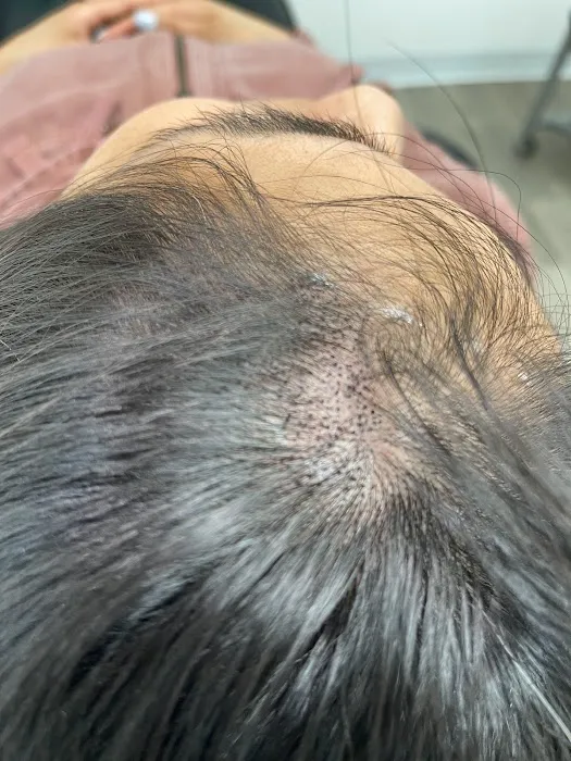 Bald Solution LLc Scalp Micropigmentation 6