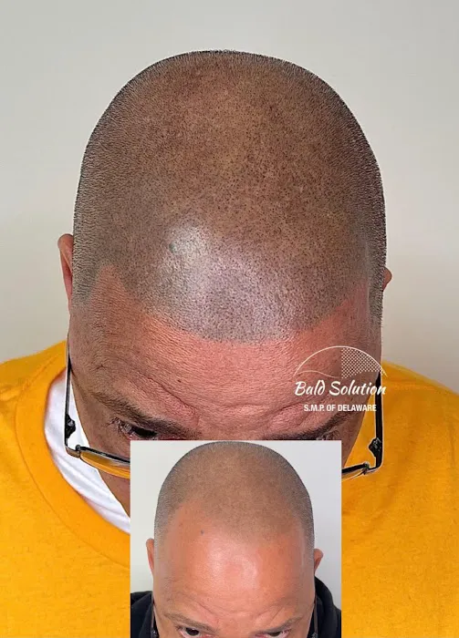 Bald Solution LLc Scalp Micropigmentation 3