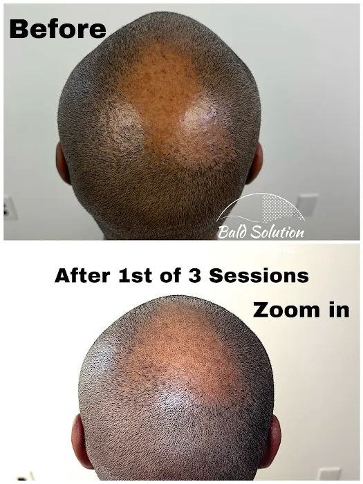 Bald Solution LLc Scalp Micropigmentation 7