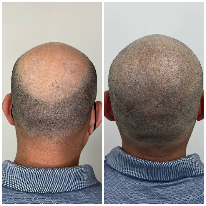 Bald Solution LLc Scalp Micropigmentation 1