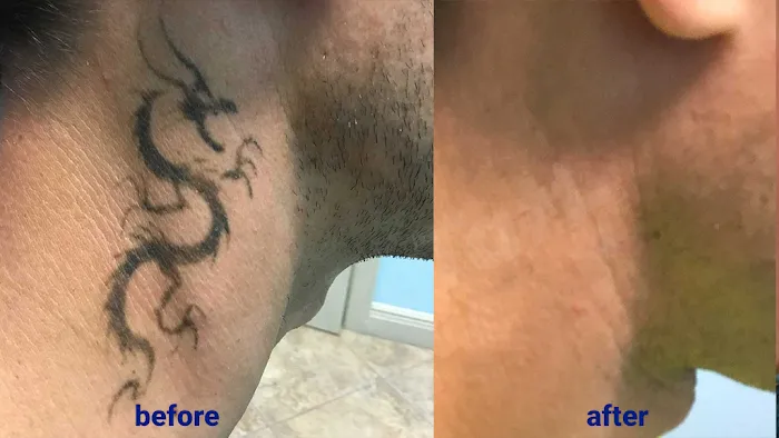 TakeTatt Tattoo Removal 5