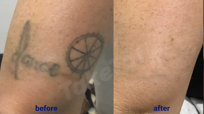TakeTatt Tattoo Removal 9