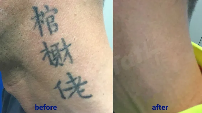 TakeTatt Tattoo Removal 8