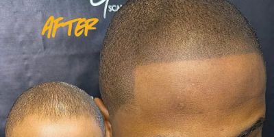 Goscalp Scalp Micropigmentation Hair Loss Center