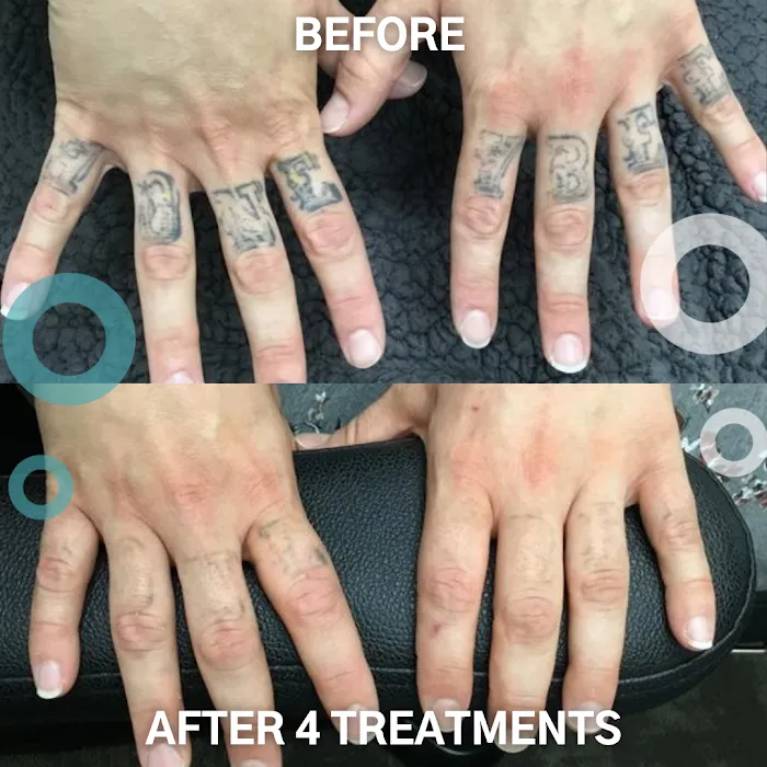 Removery Tattoo Removal & Fading 9