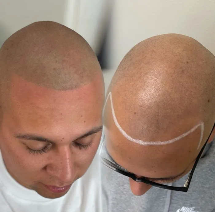 Scalp Therapy Micropigmentation 4