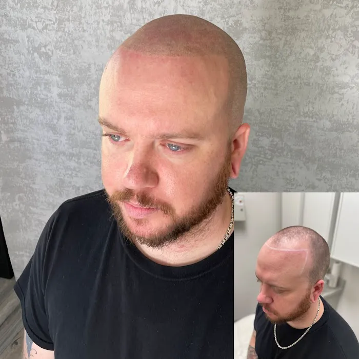 Scalp Therapy Micropigmentation 6