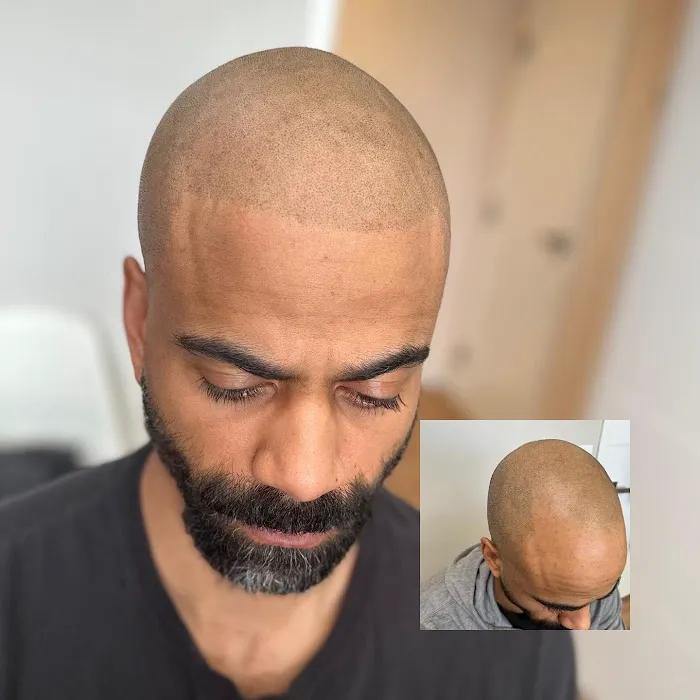 Scalp Therapy Micropigmentation 3