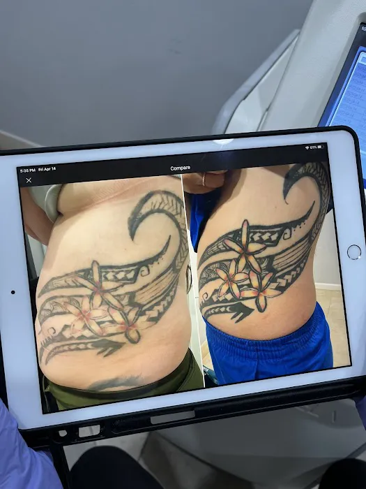 Removery Tattoo Removal & Fading 1