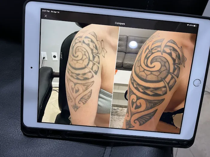 Removery Tattoo Removal & Fading 2