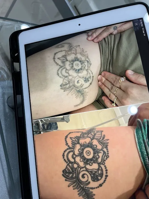 Removery Tattoo Removal & Fading 0