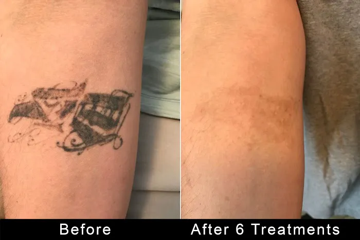 TattooRemovers.ink 7