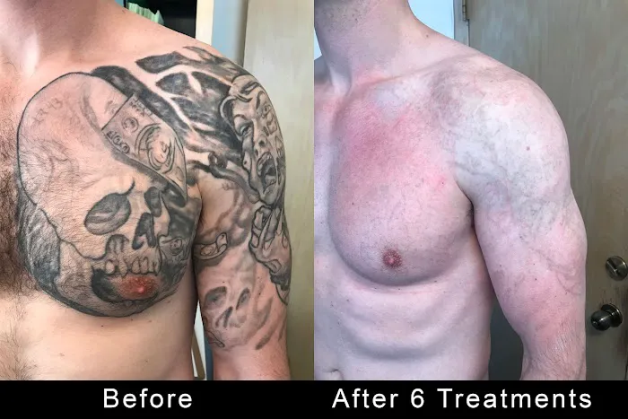 TattooRemovers.ink 1