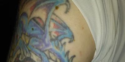 Removery Tattoo Removal & Fading