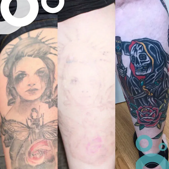 Removery Tattoo Removal & Fading 0