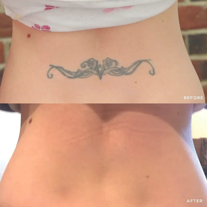 Removery Tattoo Removal & Fading 5