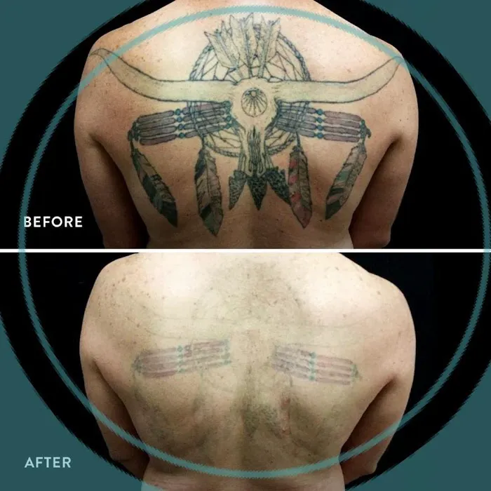 Removery Tattoo Removal & Fading 7