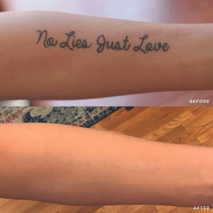 Removery Tattoo Removal & Fading 3