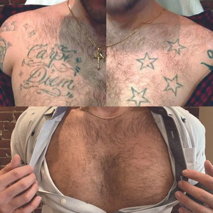 Removery Tattoo Removal & Fading 6